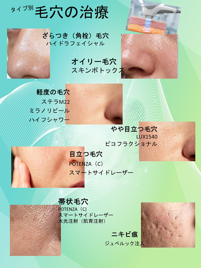 タイプ別毛穴の治療