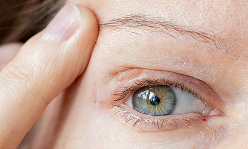 炎症性色素沈着