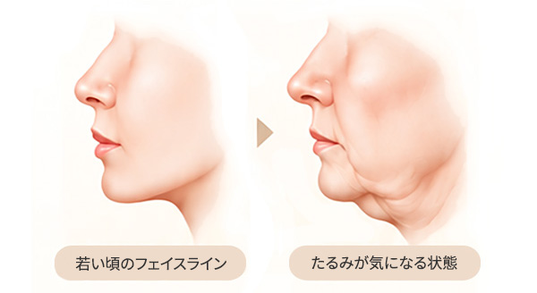 若い頃のフェイスラインとたるみが気になる状態への変化
