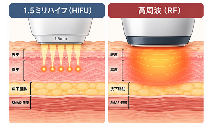 1.5mmハイフと高周波（RF）の違い