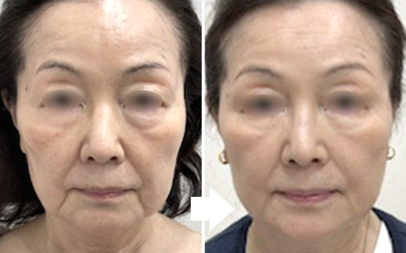 真皮線維芽細胞療法で安全に自然な若さ