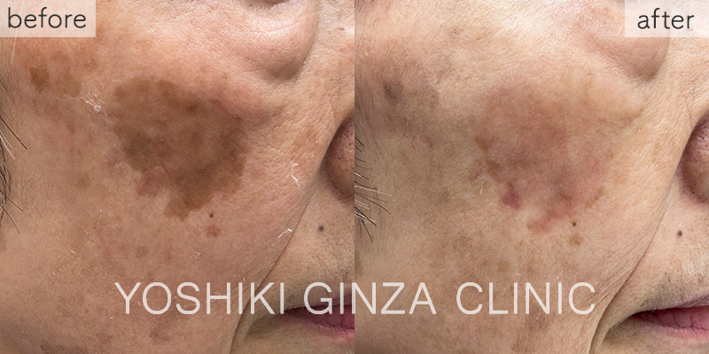 シミ取りレーザーの症例写真