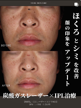 ほくろとシミを改善!顔の印象をアップデート