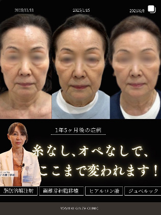 糸なし、オペなしで、ここまで変われます!