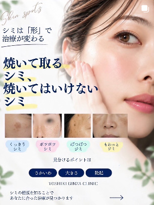 焼いて取るシミ、焼いてはいけないシミ